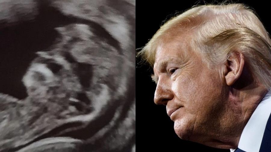 O casal ficou chocado ao fazer o ultrassom e perceber que o bebê se parece com o Donald Trump - Reprodução/Kennedy News Media e BRENDAN SMIALOWSKI/AFP