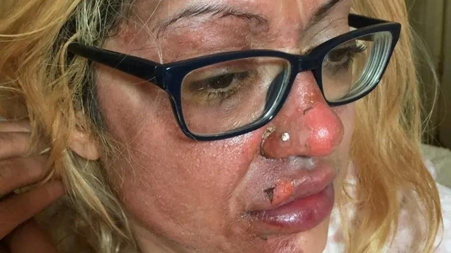 Shafia Bashir queimou o rosto ao cozinhar ovo no micro-ondas - Reprodução/Twitter