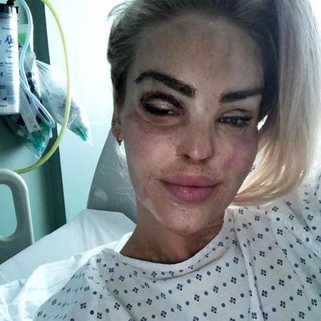 Katie revelou ter passado por mais de 350 procedimentos cirúrgicos para recuperação das queimaduras - Instagram/Katie Piper