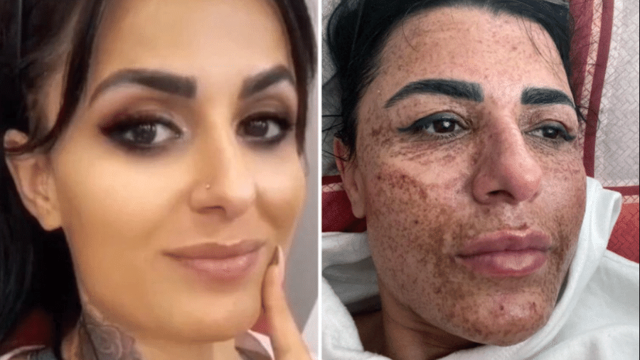Asli Ilhan ficou com marcas permanentes no rosto após acidente durante tratamento facial. - Reprodução/The Sun