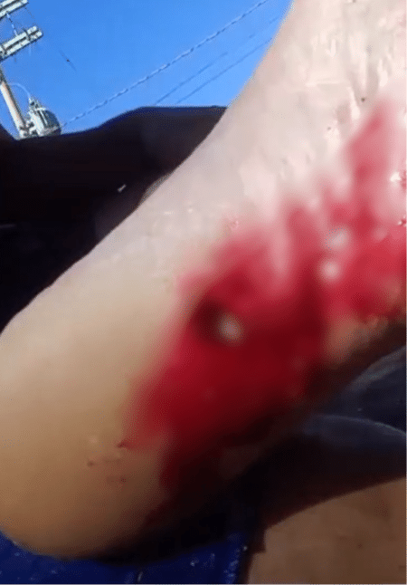 Homem mostra pé ferido por piranha em vídeo 