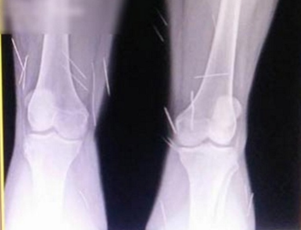 Radiografia mostra agulhas que foram inseridas nas pernas de uma mulher de 32 anos  - Site Patos Hoje
