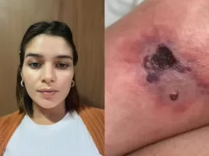Grávida picada por aranha: 'Pele estava necrosando, tinha veneno no sangue'