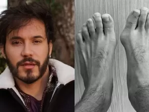 Antes e depois: Eliezer Netto faz cirurgia nos pés para corrigir joanetes