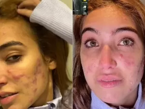 Vanessa Lopes chora ao mostrar crise de acne no rosto: "Doem muito"