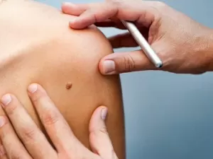 Ciência avança em vacina contra o câncer de pele