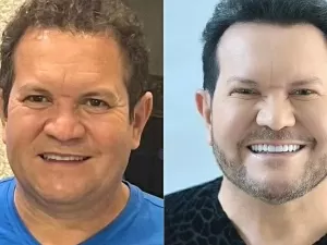 Ximbinha mostra antes e depois de lipo de papada e rinoplastia: "Sempre sonhei"