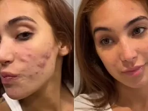 Vanessa Lopes mostra evolução de tratamento para acne severa: "Dói muito"