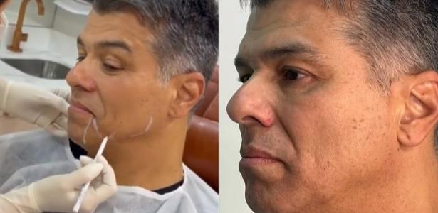 Maurício Mattar antes de realizar a harmonização facial - undefined