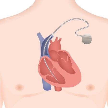 Marcapasso cardíaco trata certos tipos de arritmias - iStock