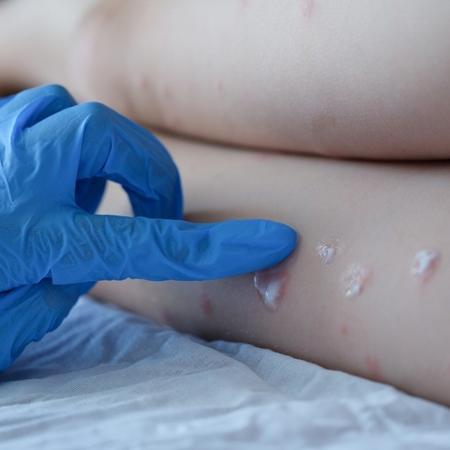 Varíola do macaco (monkeypox) causa bolhas e é de fácil detecção - Gettyimages