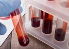 Um simples exame de sangue pode revolucionar diagnósticos de Alzheimer - Reprodução