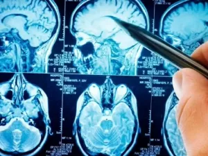 Poluição do ar pode ter efeitos graves na saúde cerebral; saiba mais