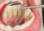 Sua boca abriga bactéria que se reproduz de forma inusitada - Reprodução