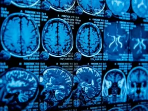 Cientistas criam bilhões de nanorrobôs para combater aneurismas cerebrais