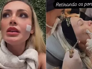 Andressa Urach retira pontos de rosto após briga com Juju Ferrari: veja o vídeo