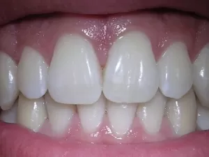 Fim dos implantes? Novo medicamento promete regenerar dentes em humanos