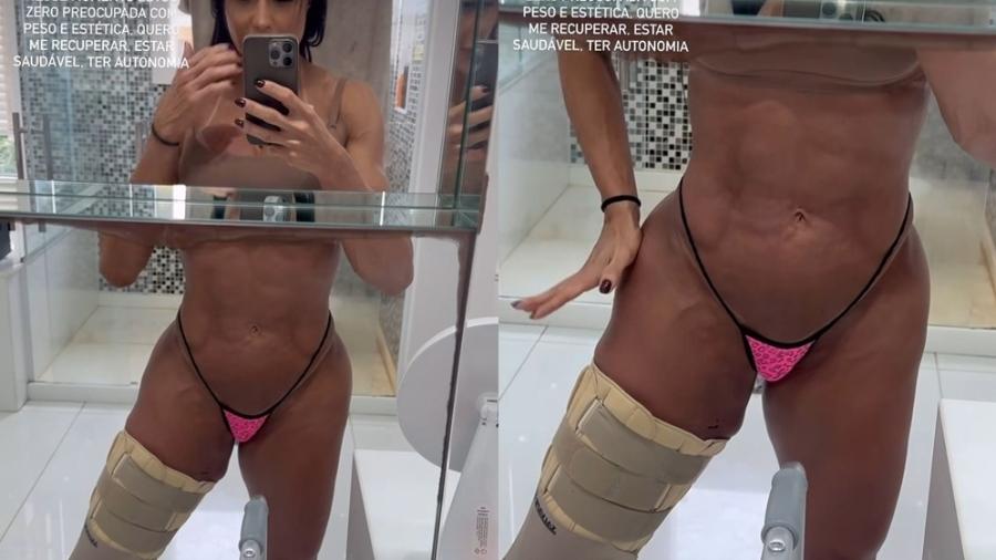 Gracyanne Barbosa mostra perna enfaixada após cirurgia