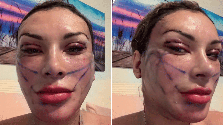 Andressa Urach mostrou como o rosto está após cirurgia de R$ 100 mil - undefined
