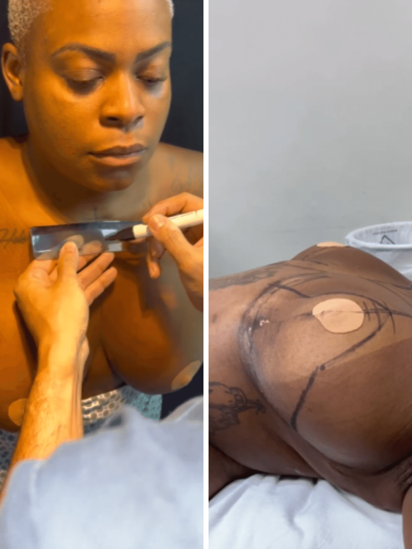 Jojo Todynho mostra cirurgia de redu&ccedil;&atilde;o de mamas
