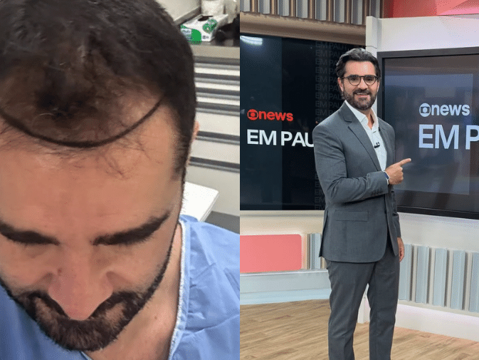 Antes e Depois: Jornalista da GloboNews Revela Transplante Capilar e Surpreende