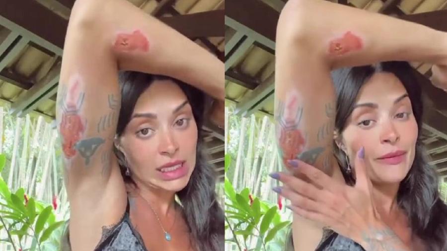 Aline Campos mostrou ferimentos em rede social - Reprodução/Instagram