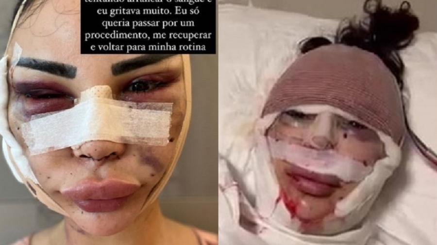 Modelo mostra rosto machucado e denuncia maus-tratos na Turquia
