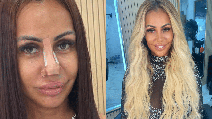 Débora Dunhill fez harmonização após conselhos de ChatGPT