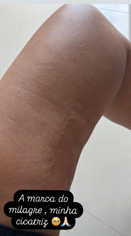 Vera Viel mostra cicatriz da retirada de seu tumor