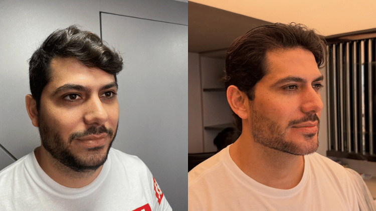 Yugnir fez harmonização facial e mostrou o resultado