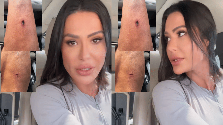 Gracyanne Barbosa mostra cicatriz de acidente em academia
