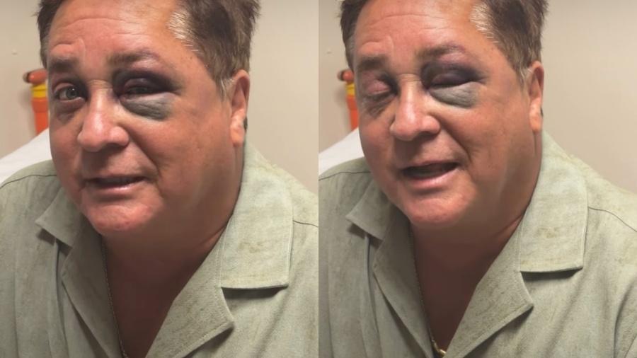 Leonardo sofre acidente em pescaria e aparece com olho roxo