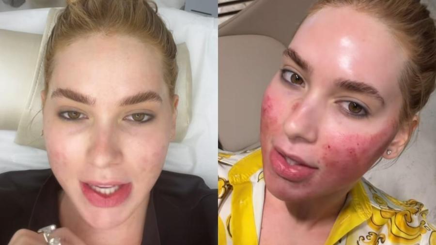 Virginia Fonseca Revela Transformação Pós-Procedimentos Estéticos e Tranquiliza Fãs