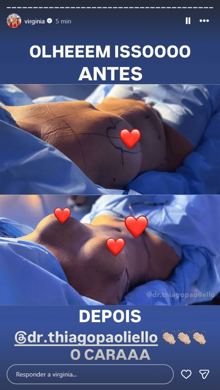 Mudou muito? Mãe de Virignia passa por transformação após procedimento estético