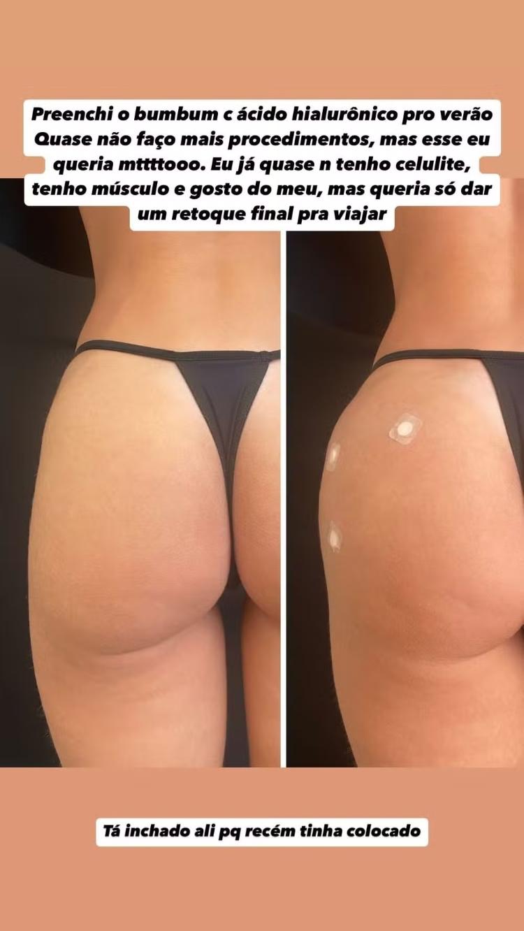 Maria Lina exibe antes e depois do bumbum