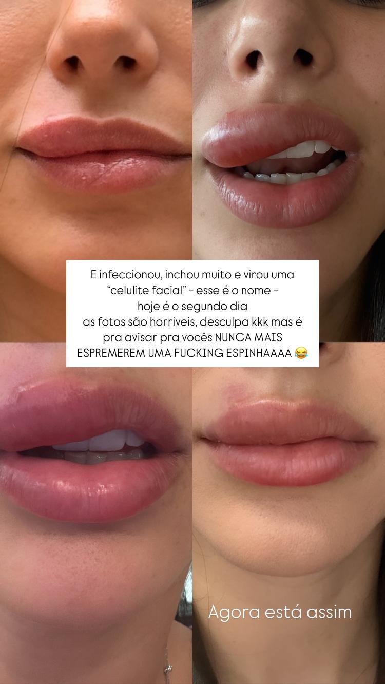 Bruna Biancardi shows swelling in her mouth after squeezing a pimple