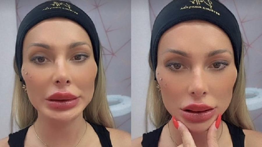 Andressa Urach fez uma nova intervenção estética - Reprodução/Instagram