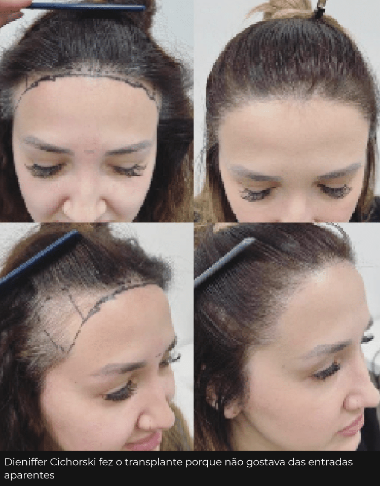 foto transplante capilar dieniffer dsk - undefined