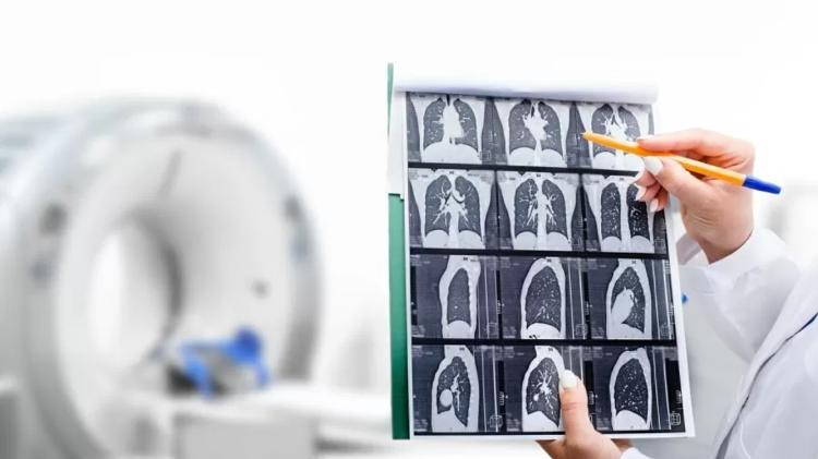 pulmão - iStock - iStock